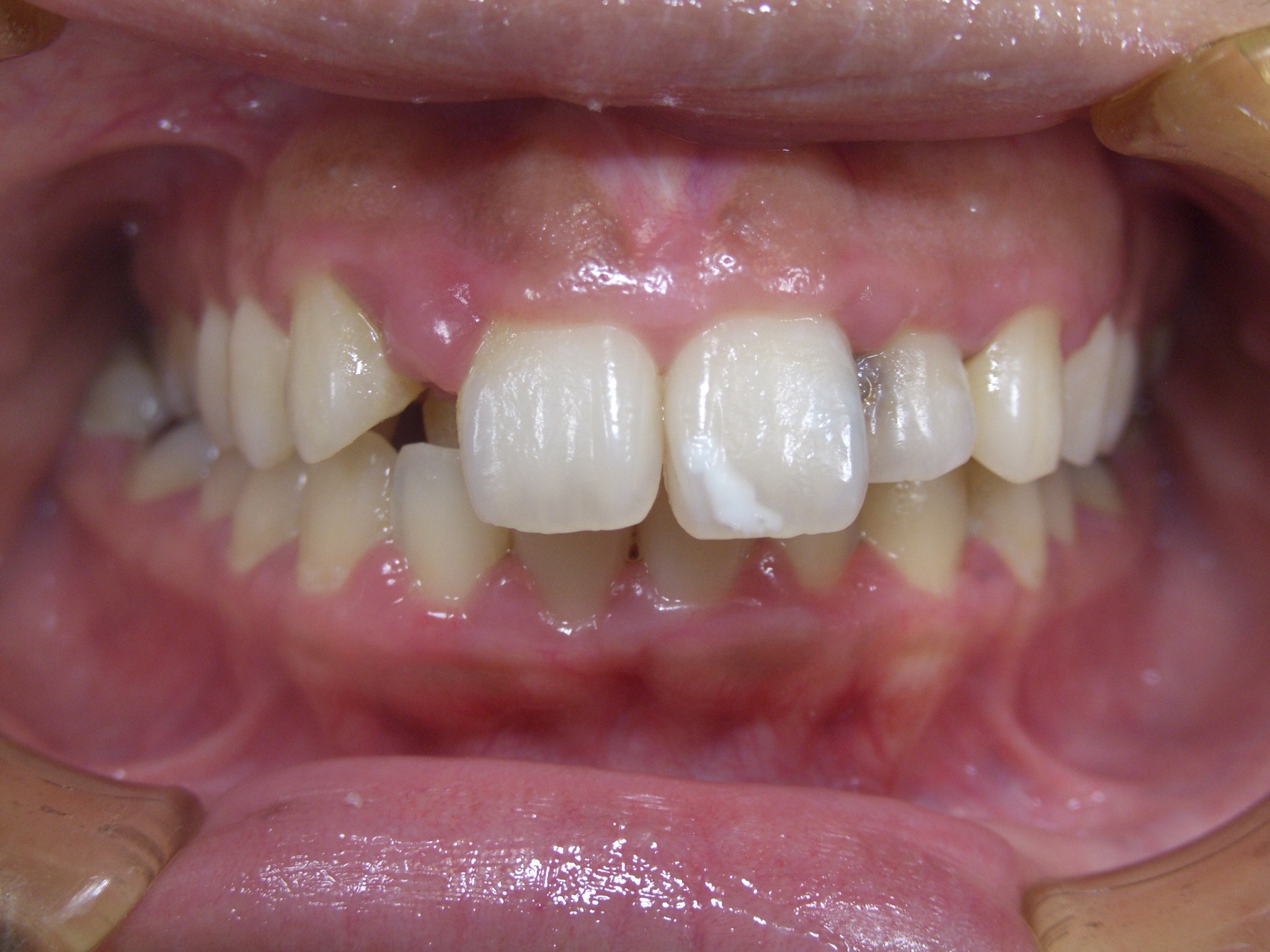 歯周病 専門治療 症例実績 山形市の歯医者 南館歯科クリニック マイクロスコープ下での精密治療