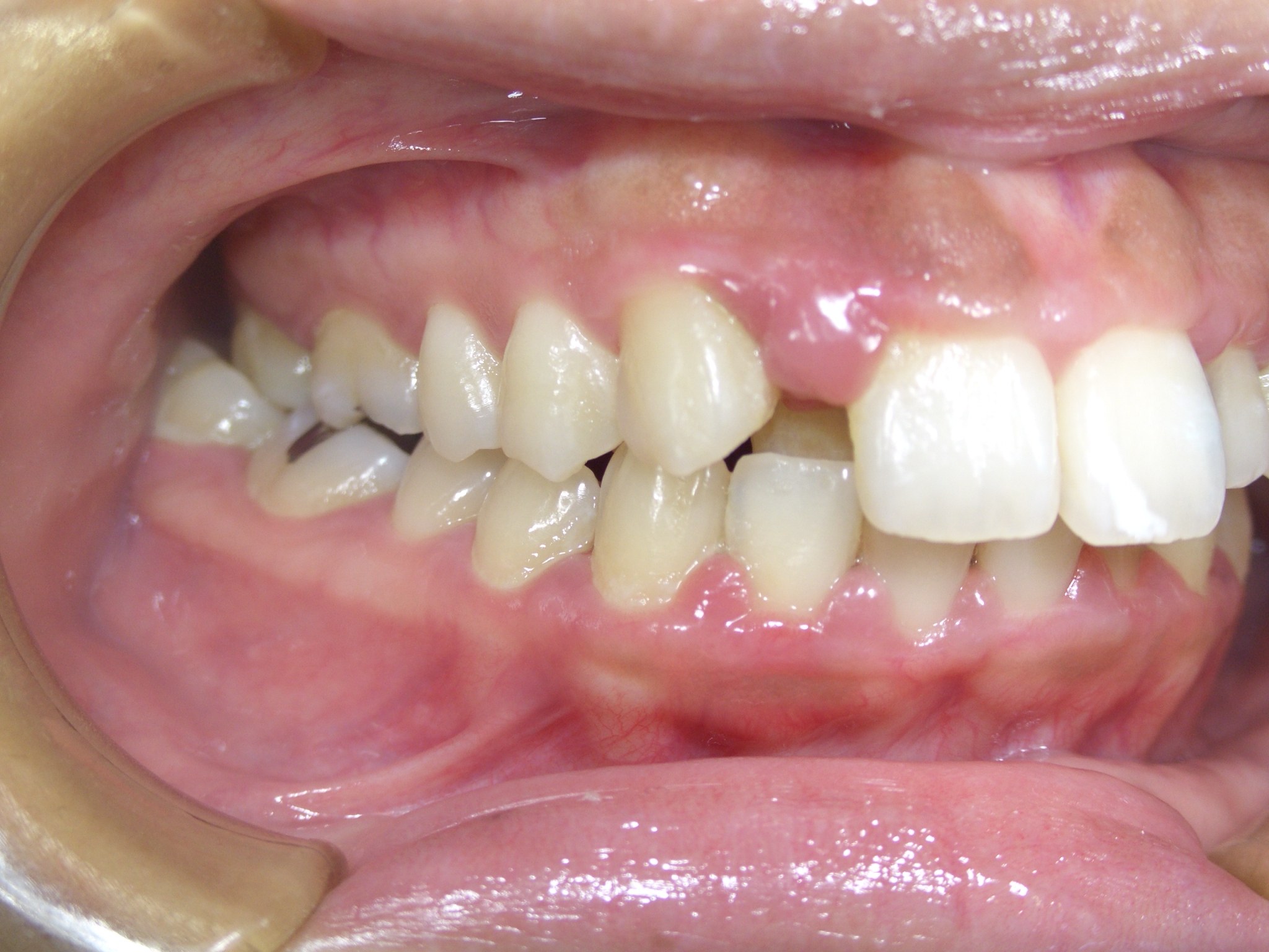 歯周病 専門治療 症例実績 山形市の歯医者 南館歯科クリニック マイクロスコープ下での精密治療