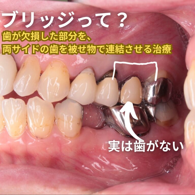 | ブリッジになんてしなきゃよかった・・・ | 山形市の歯医者|南館歯科クリニック・矯正歯科